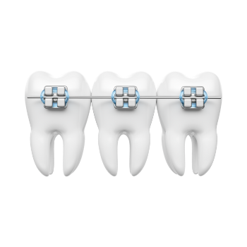 Braces - nConnect 1